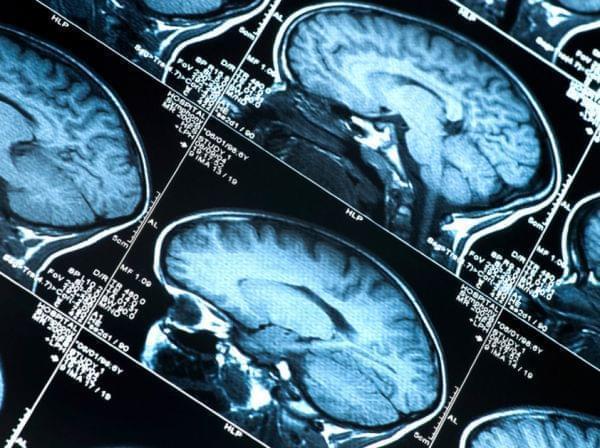 Doctors may eventually be able to diagnose "preclinical" Alzheimer's in patients who have abnormal brain scans but who aren't yet showing behavioral symptoms of the disease.